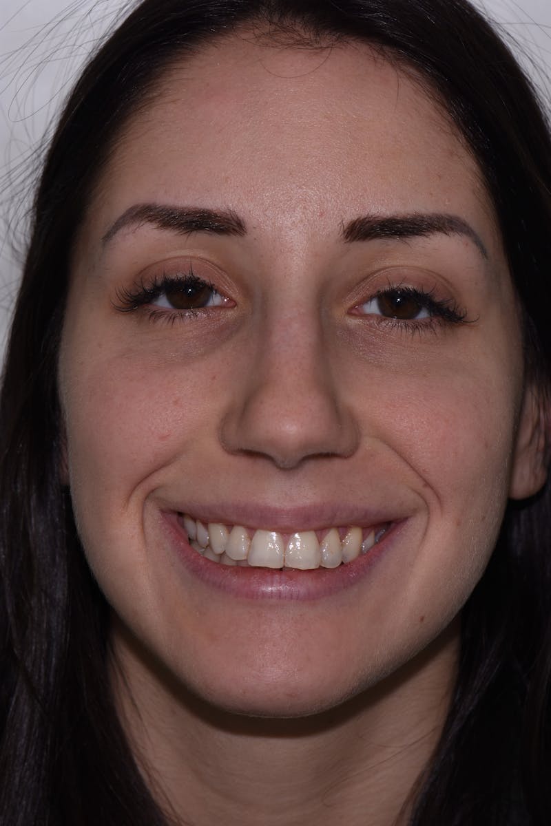 Patient Smile Before & After Gallery - Patient 408679 - Image 1