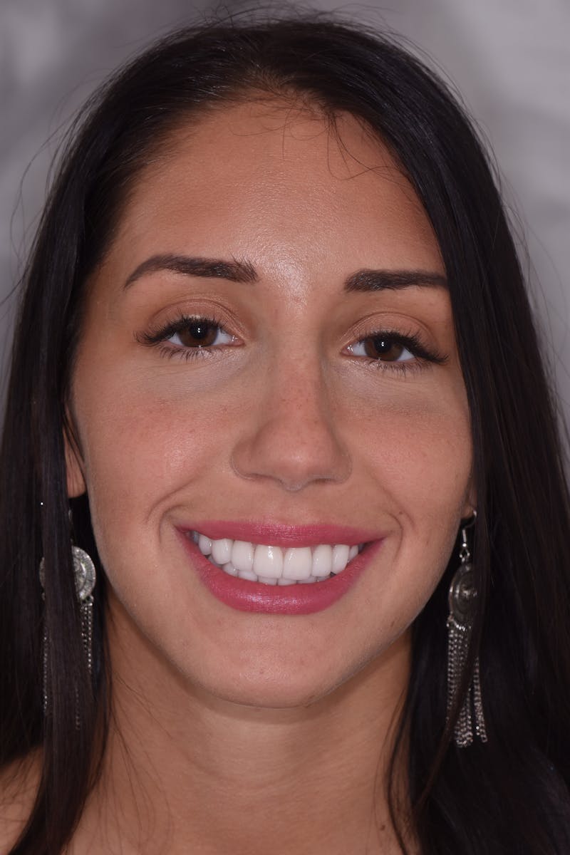 Patient Smile Before & After Gallery - Patient 408679 - Image 2