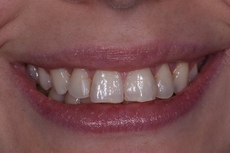Patient Smile Before & After Gallery - Patient 408679 - Image 3