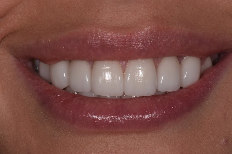 Patient Smile Before & After Gallery - Patient 408679 - Image 4
