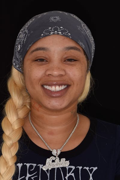 Patient Smile Before & After Gallery - Patient 194595 - Image 1