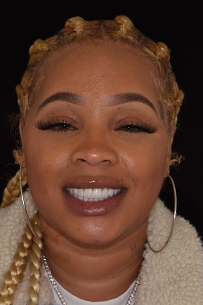 Patient Smile Before & After Gallery - Patient 194595 - Image 2