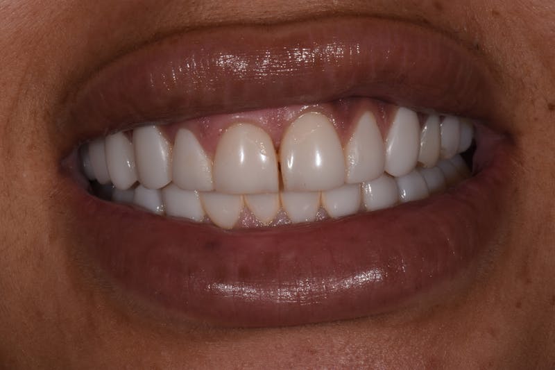 Patient Smile Before & After Gallery - Patient 194595 - Image 3
