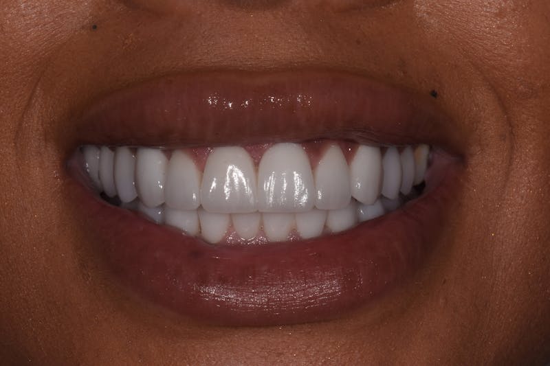 Patient Smile Before & After Gallery - Patient 194595 - Image 4