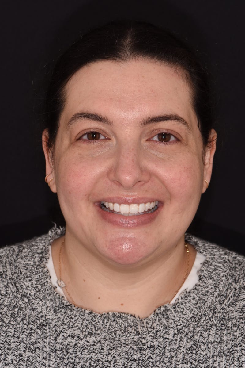 Patient Smile Before & After Gallery - Patient 324025 - Image 1