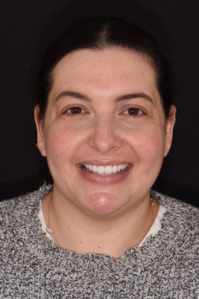 Patient Smile Before & After Gallery - Patient 324025 - Image 1