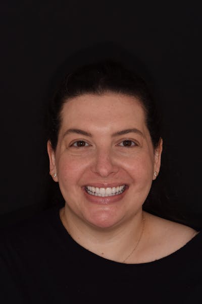 Patient Smile Before & After Gallery - Patient 324025 - Image 2