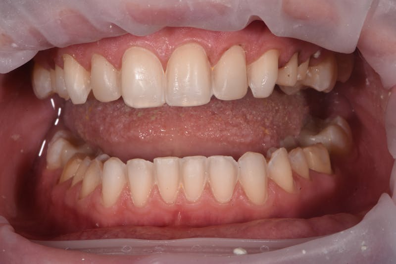 Patient Smile Before & After Gallery - Patient 324025 - Image 4