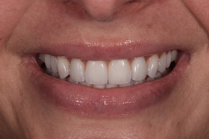 Patient Smile Before & After Gallery - Patient 324025 - Image 6