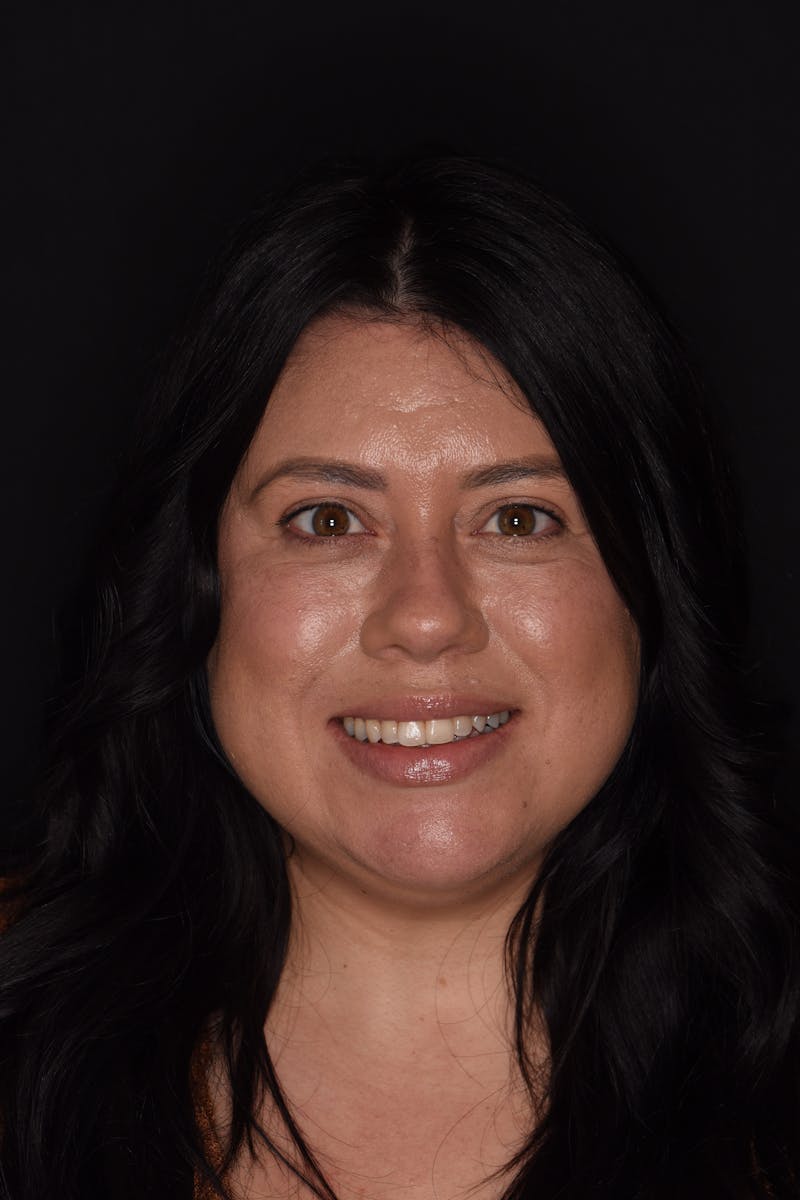 Patient Smile Before & After Gallery - Patient 366903 - Image 1