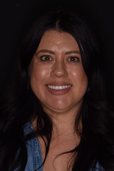 Patient Smile Before & After Gallery - Patient 366903 - Image 2