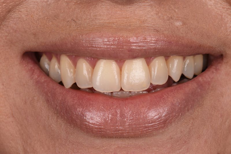 Patient Smile Before & After Gallery - Patient 366903 - Image 3