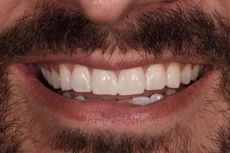 Patient Smile Before & After Gallery - Patient 369809 - Image 1