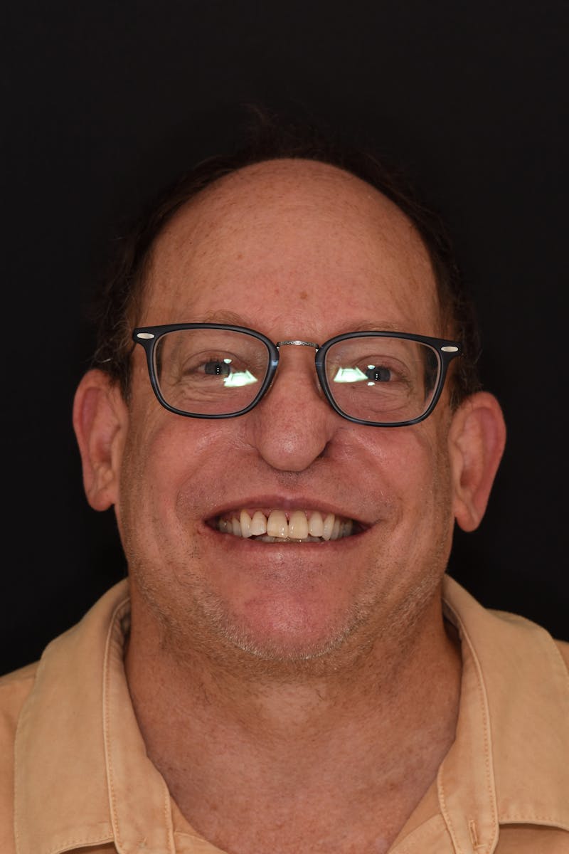 Patient Smile Before & After Gallery - Patient 196369 - Image 1