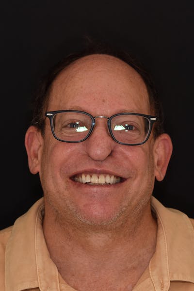 Patient Smile Before & After Gallery - Patient 196369 - Image 1