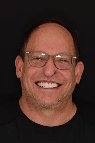 Patient Smile Before & After Gallery - Patient 196369 - Image 2