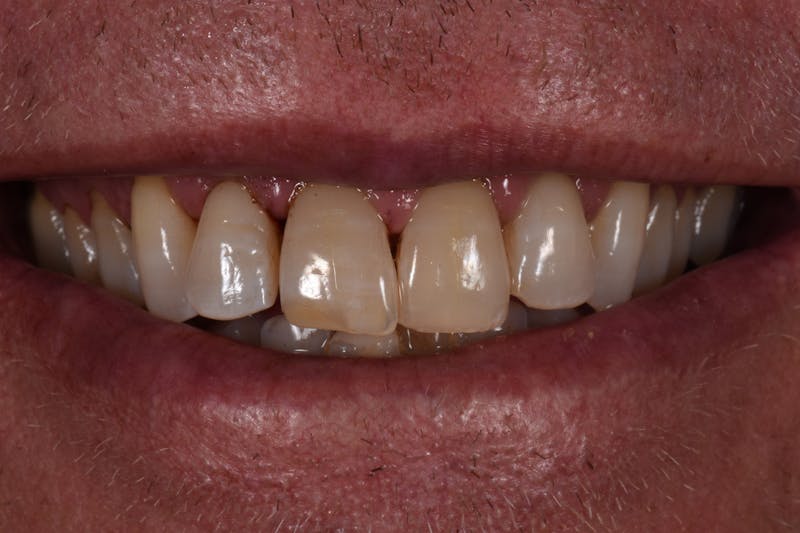 Patient Smile Before & After Gallery - Patient 196369 - Image 3