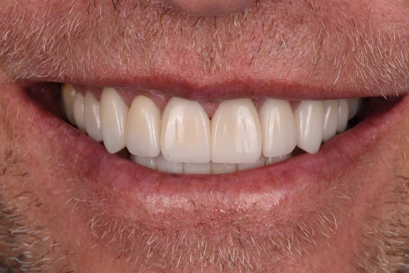 Patient Smile Before & After Gallery - Patient 196369 - Image 4