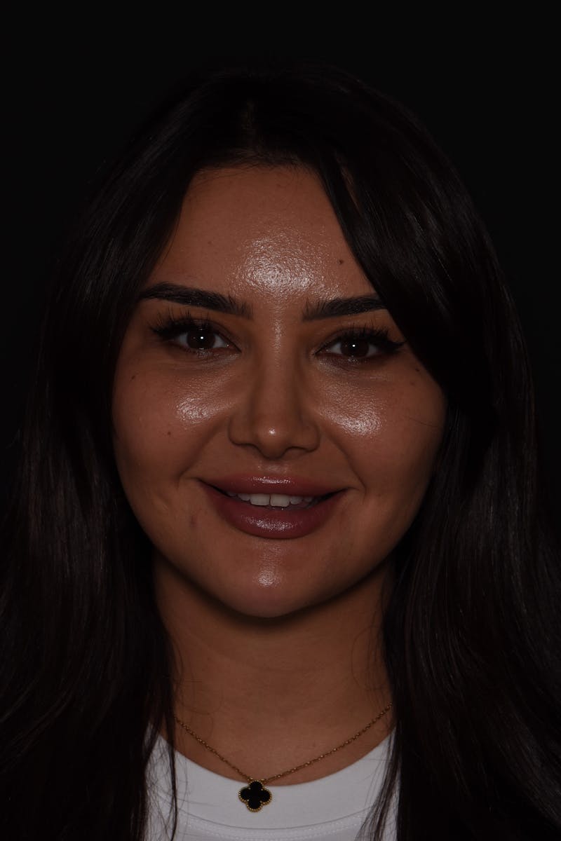 Patient Smile Before & After Gallery - Patient 269817 - Image 1