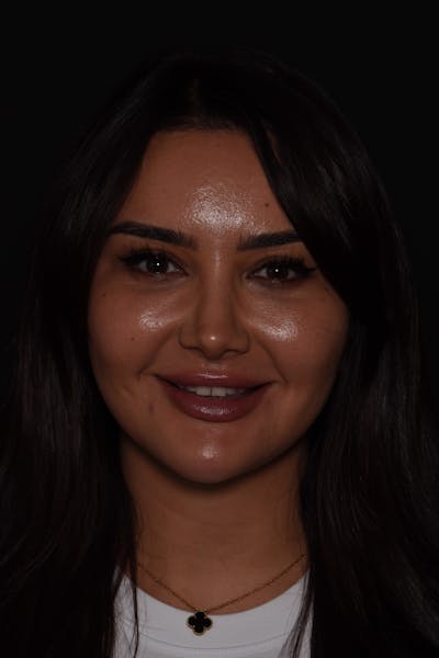 Patient Smile Before & After Gallery - Patient 269817 - Image 1