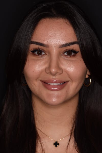 Patient Smile Before & After Gallery - Patient 269817 - Image 2