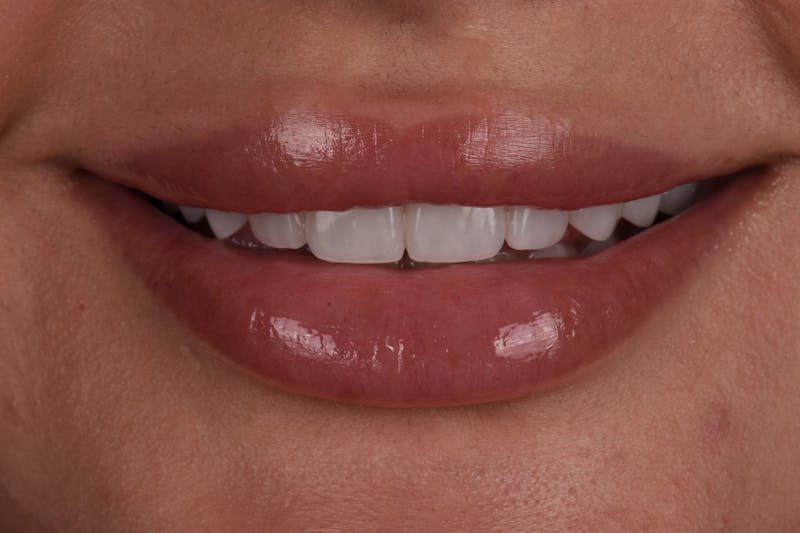 Patient Smile Before & After Gallery - Patient 269817 - Image 4