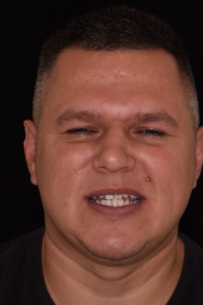 Patient Smile Before & After Gallery - Patient 163670 - Image 1