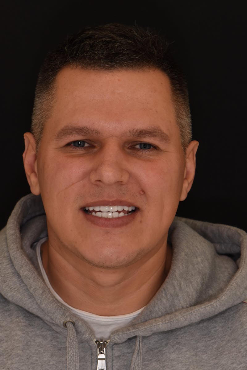 Patient Smile Before & After Gallery - Patient 163670 - Image 2