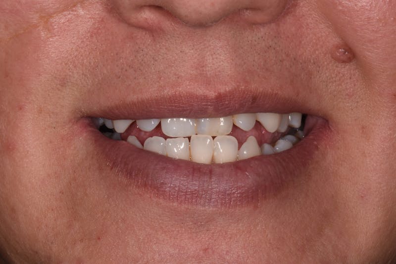 Patient Smile Before & After Gallery - Patient 163670 - Image 3