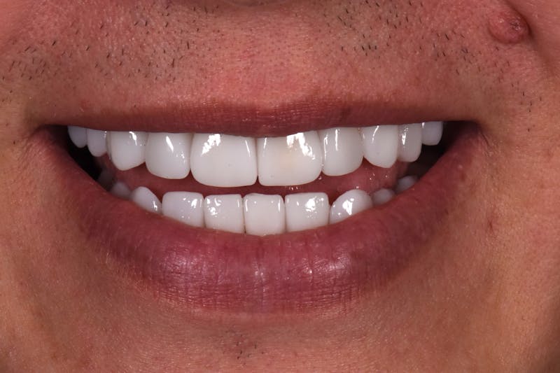 Patient Smile Before & After Gallery - Patient 163670 - Image 4