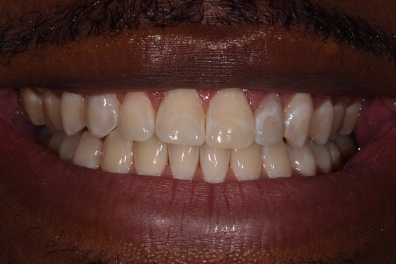 Patient Smile Before & After Gallery - Patient 947598 - Image 3