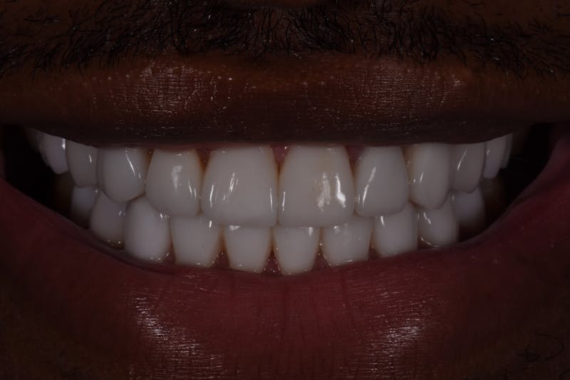 Patient Smile Before & After Gallery - Patient 947598 - Image 4