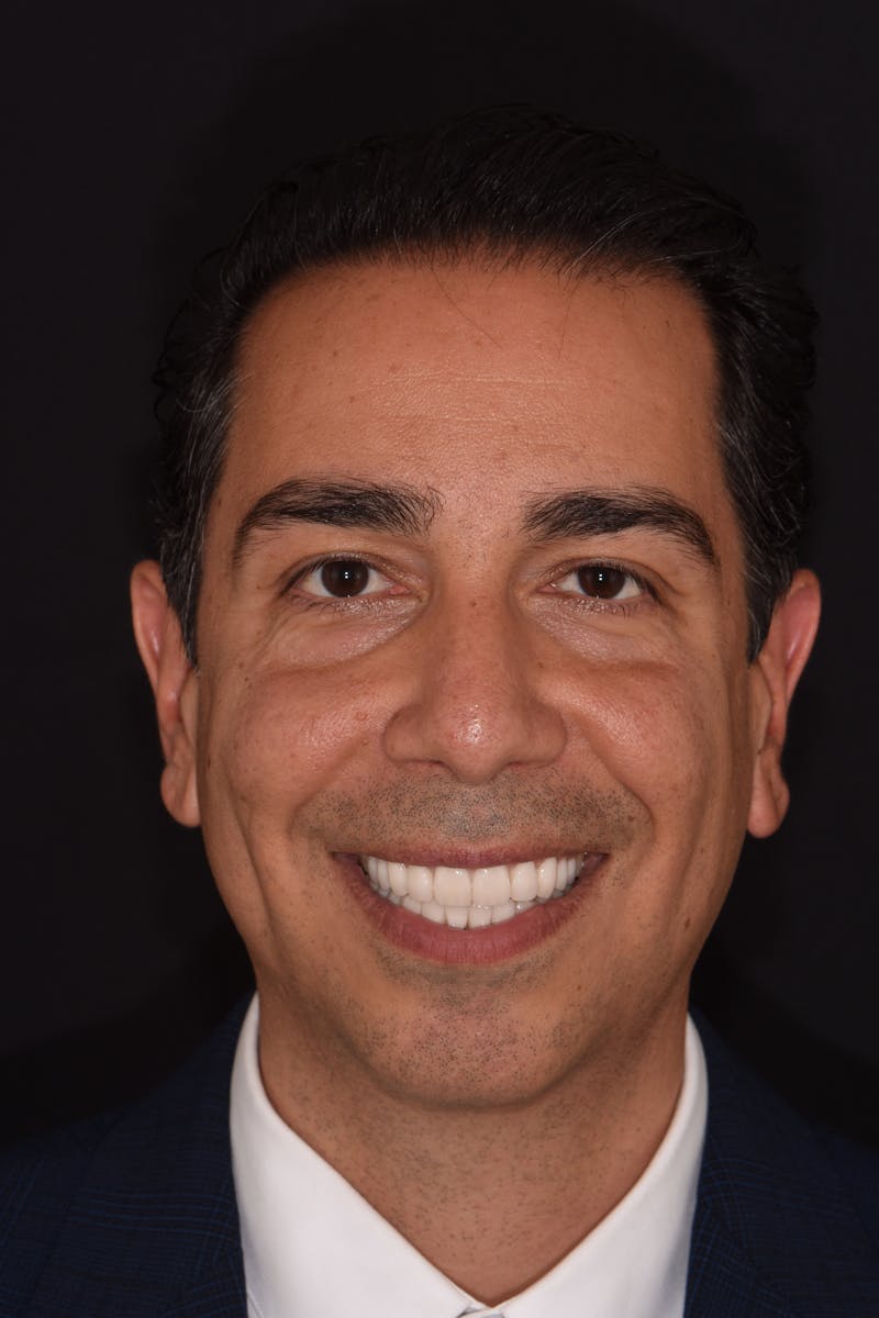 Patient Smile Before & After Gallery - Patient 316550 - Image 2