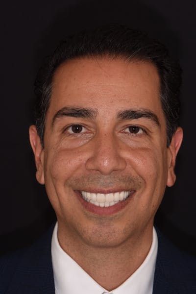 Patient Smile Before & After Gallery - Patient 316550 - Image 2