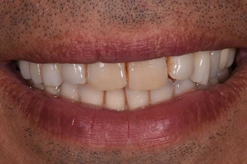 Patient Smile Before & After Gallery - Patient 316550 - Image 3