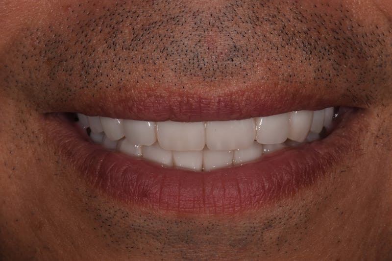 Patient Smile Before & After Gallery - Patient 316550 - Image 4