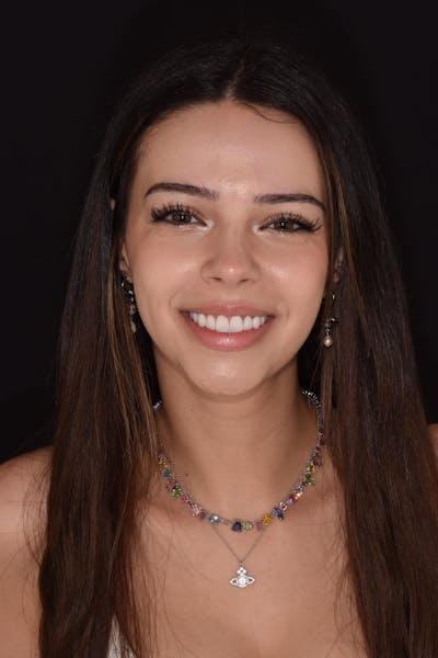 Patient Smile Before & After Gallery - Patient 121650 - Image 2