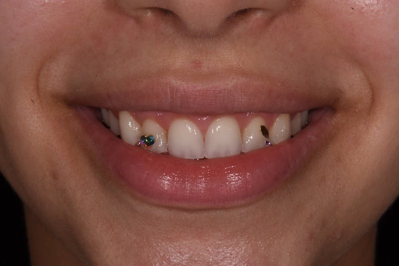 Patient Smile Before & After Gallery - Patient 121650 - Image 3