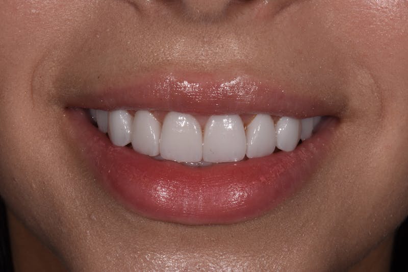 Patient Smile Before & After Gallery - Patient 121650 - Image 4