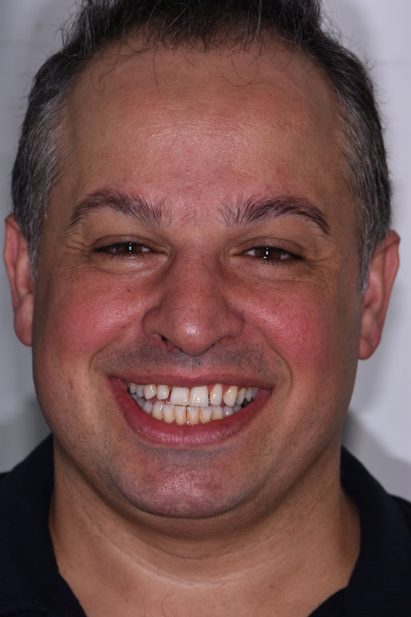 Patient Smile Before & After Gallery - Patient 351252 - Image 1
