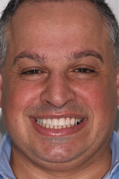 Patient Smile Before & After Gallery - Patient 351252 - Image 2