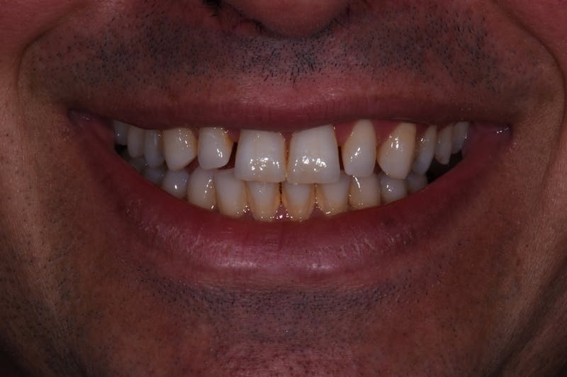 Patient Smile Before & After Gallery - Patient 351252 - Image 3