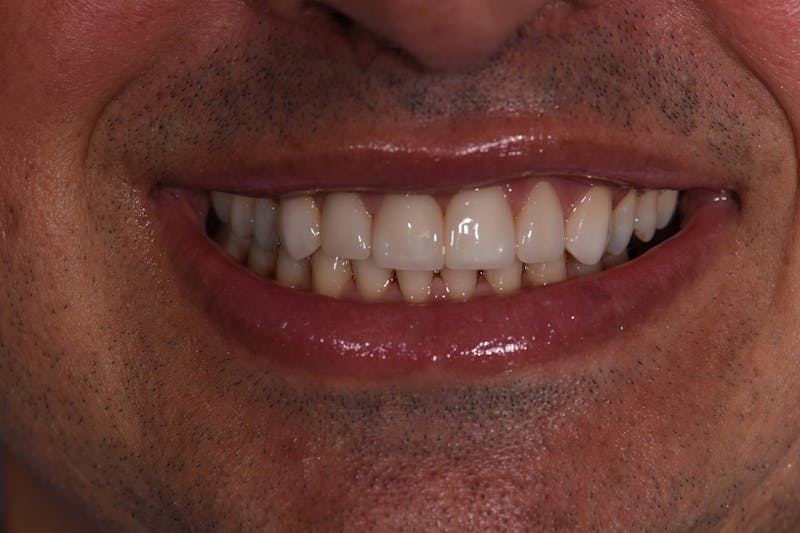 Patient Smile Before & After Gallery - Patient 351252 - Image 4