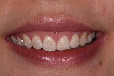 Patient Smile Before & After Gallery - Patient 381882 - Image 1