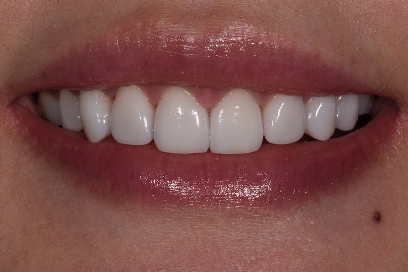 Patient Smile Before & After Gallery - Patient 381882 - Image 2