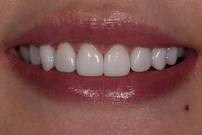 Patient Smile Before & After Gallery - Patient 381882 - Image 2