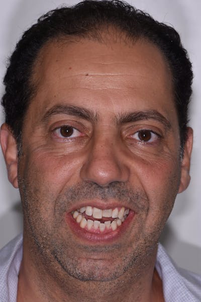 Patient Smile Before & After Gallery - Patient 212599 - Image 1