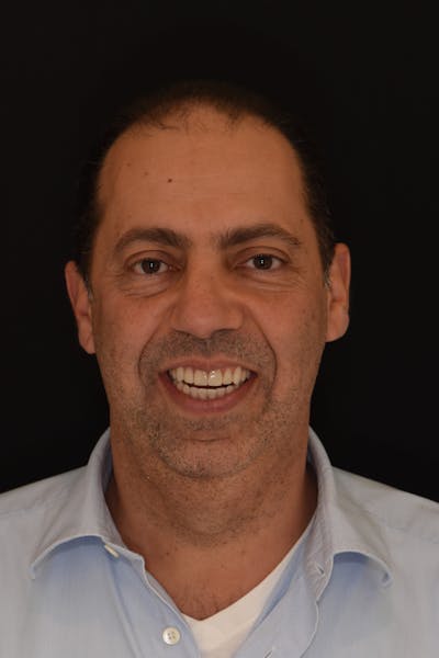 Patient Smile Before & After Gallery - Patient 212599 - Image 2