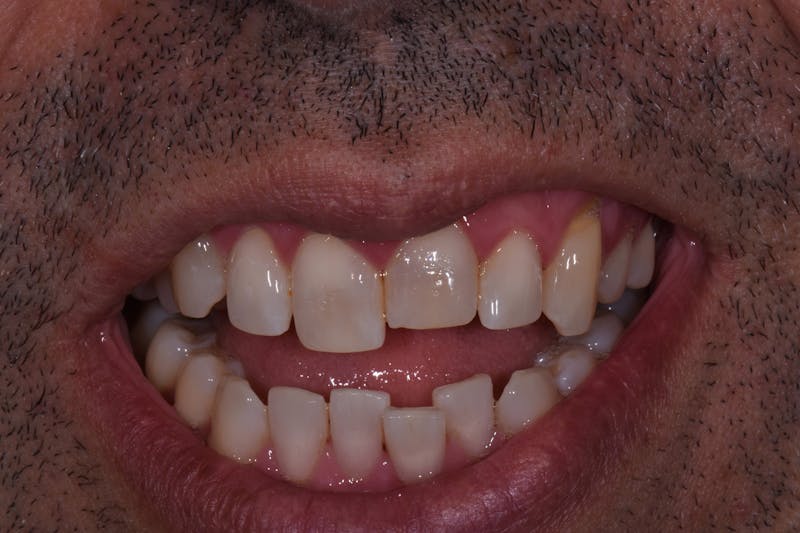 Patient Smile Before & After Gallery - Patient 212599 - Image 3