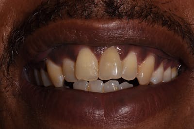 Patient Smile Before & After Gallery - Patient 433435 - Image 1